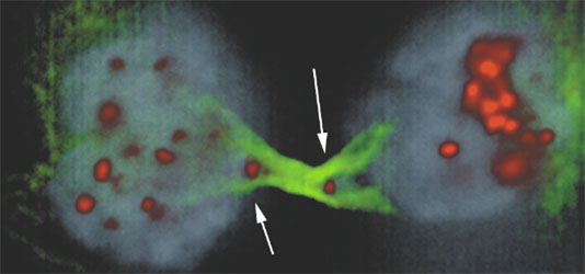 Figure 2 – Cancer cells with anaphase chromatin bridge and arrows pointing to the two centromeres that lead to a tug-of-war during mitosis interfering with cytokinesis.